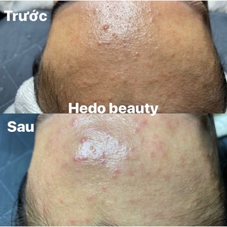 micro mask peel tẩy tế bào chết da