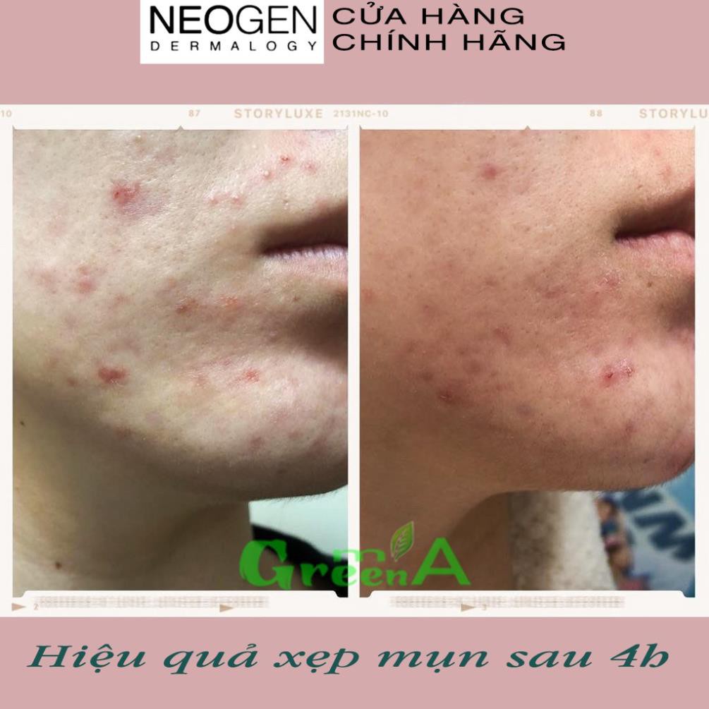 Chấm Mụn Neogen A-clear Soothing Pink Eraser 15ml Xẹp Mụn Giảm Xưng Đỏ Không Gây Kích Ứng | BigBuy360 - bigbuy360.vn