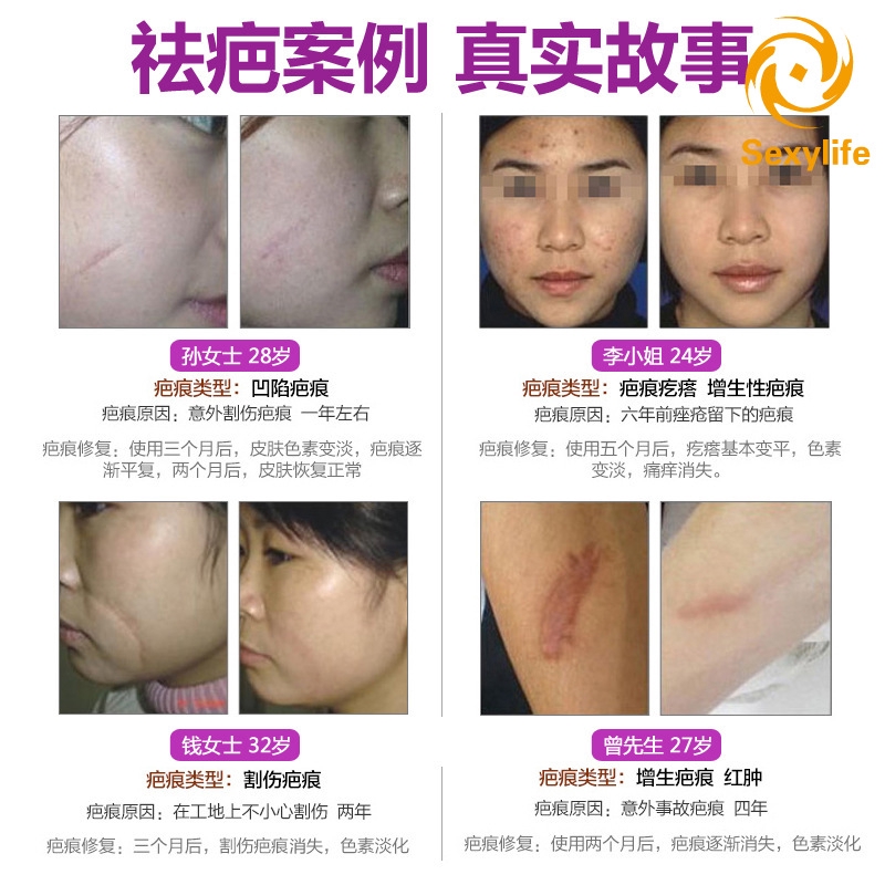 SL♣ Scar Removal Cream Lavender Cream Skin Care Natural Remove Burn Stretch Marks Ointment
