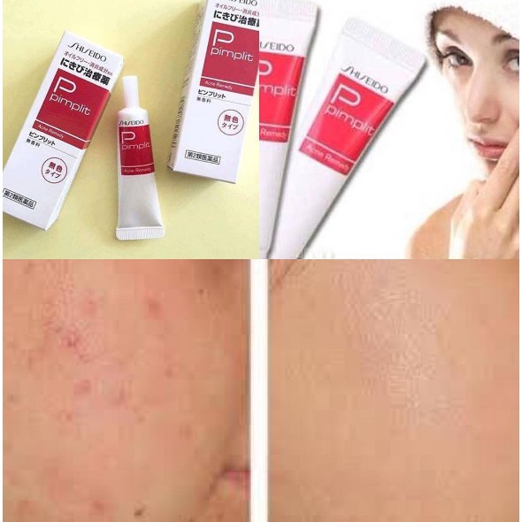 KEM HỖ TRỢ GIẢM MỤN SHISEIDO PIMPLIT