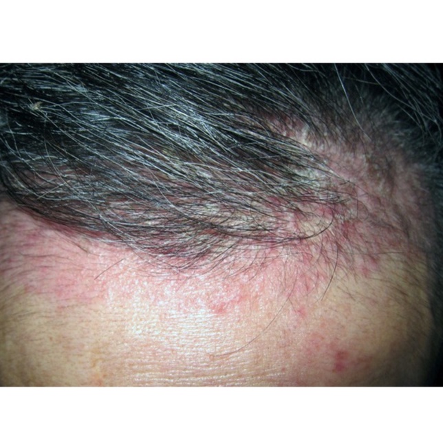 Dầu gội CANDIDTV, ngăn ngừa nấm da đầu, hỗ trợ giảm tình trạng viêm da tiết bã, gầu. | BigBuy360 - bigbuy360.vn