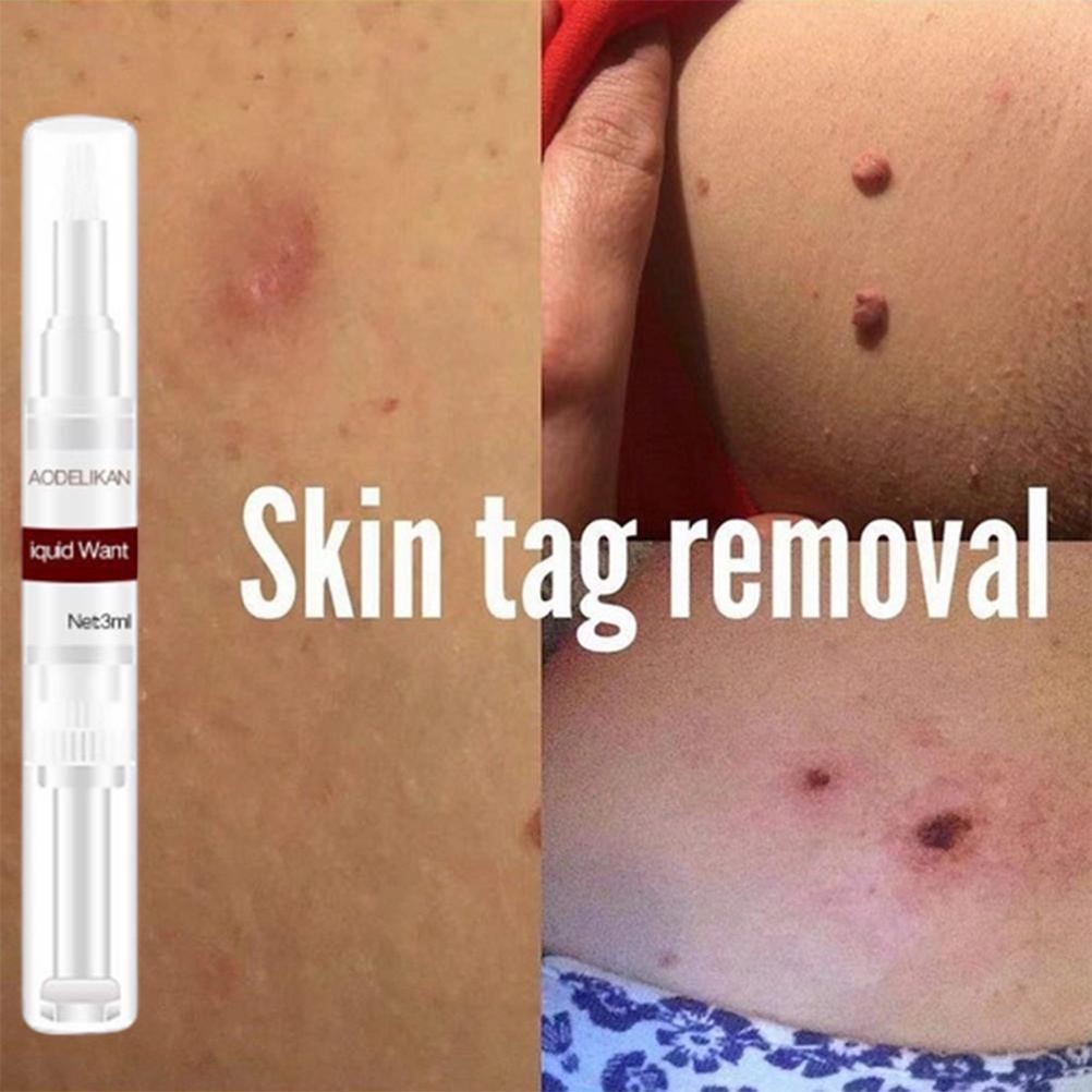 (Hàng Mới Về) Dung Dịch Loại Bỏ Mụn Thịt Nhanh Chóng 3ml | BigBuy360 - bigbuy360.vn