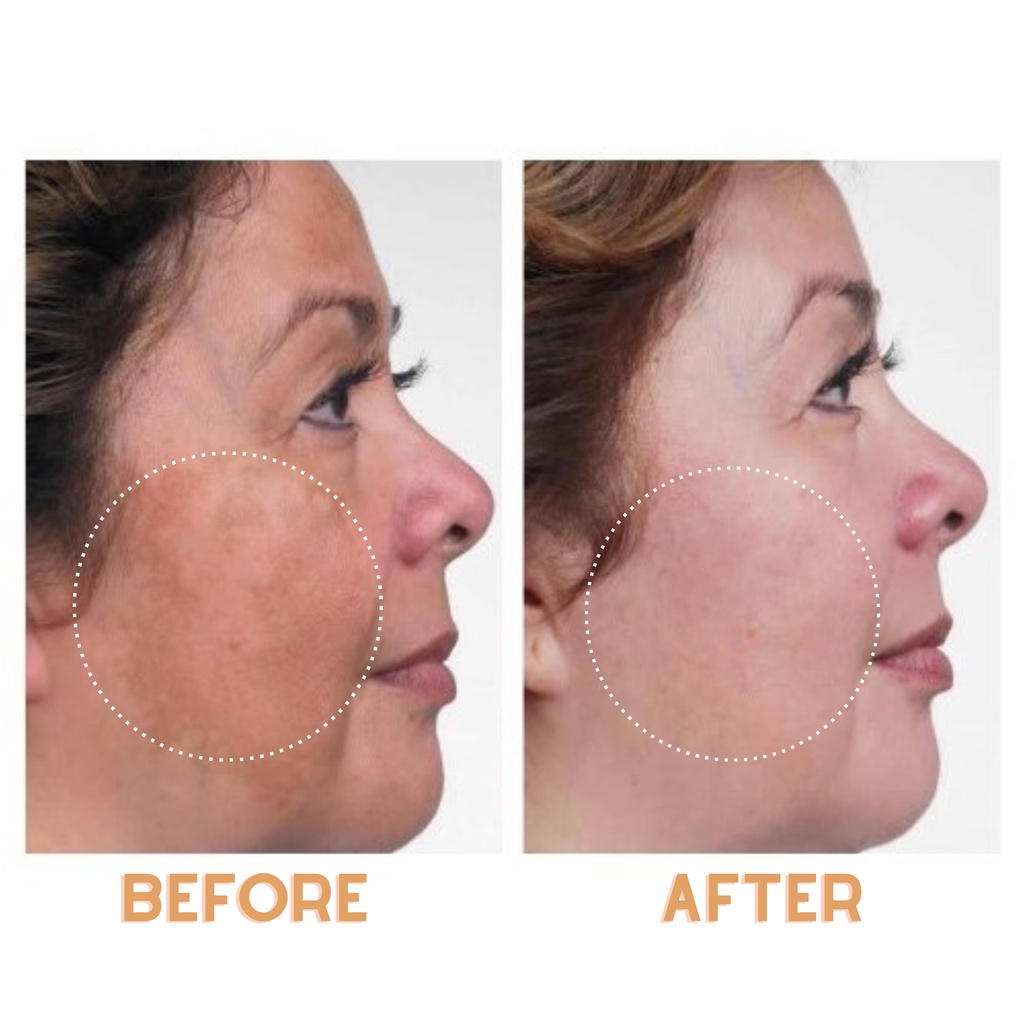 Serum Hydroquinone - Vitamin C giảm nám, thâm sạm và tàn nhang cho da trắng sáng đều màu