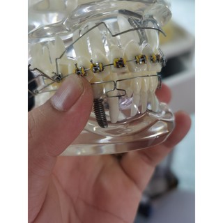 Cung tiện ích chỉnh nha, cung đánh lún ,dây SS mỹ