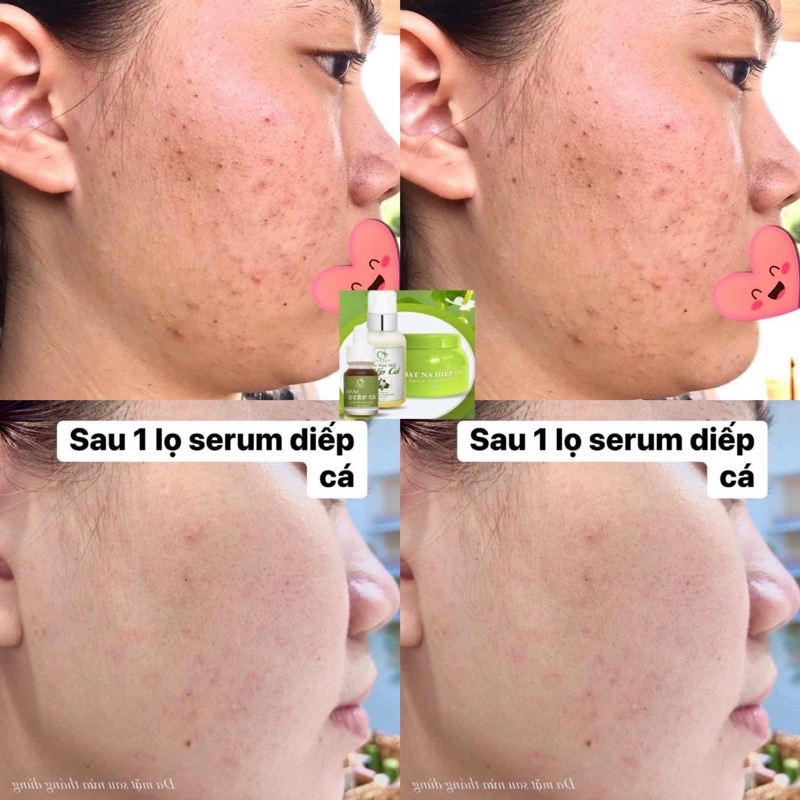 Combo 2 Sản Phẩm, Serum Diếp Cá Và Sữa Rửa Mặt Diếp Cá, Cải Thiện Làn Da Sau 7 Ngày