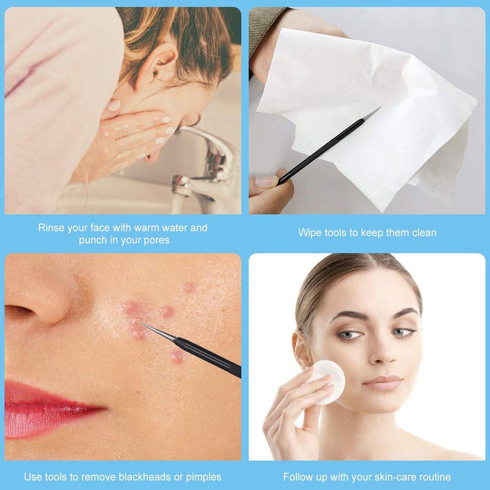 Bộ Dụng Cụ Nặn Mụn Đầu Trắng Bằng Thép Không Gỉ Kèm Hộp Đựng Tiện Lợi Dành Cho Nữ