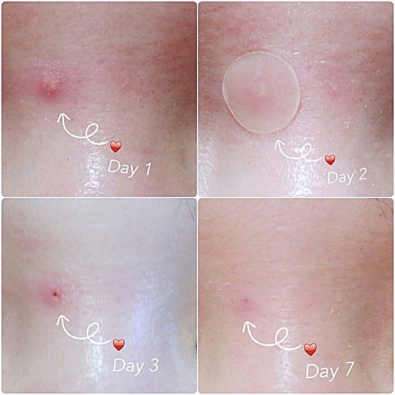 Bộ 36 Miếng Dán Che Khuyết Điểm, Che Mụn