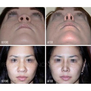 2 Kẹp Nâng Mũi Thon Gọn