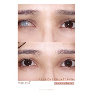 Kính áp tròng THẨM MỸ dành cho người bị hư một bên mắt