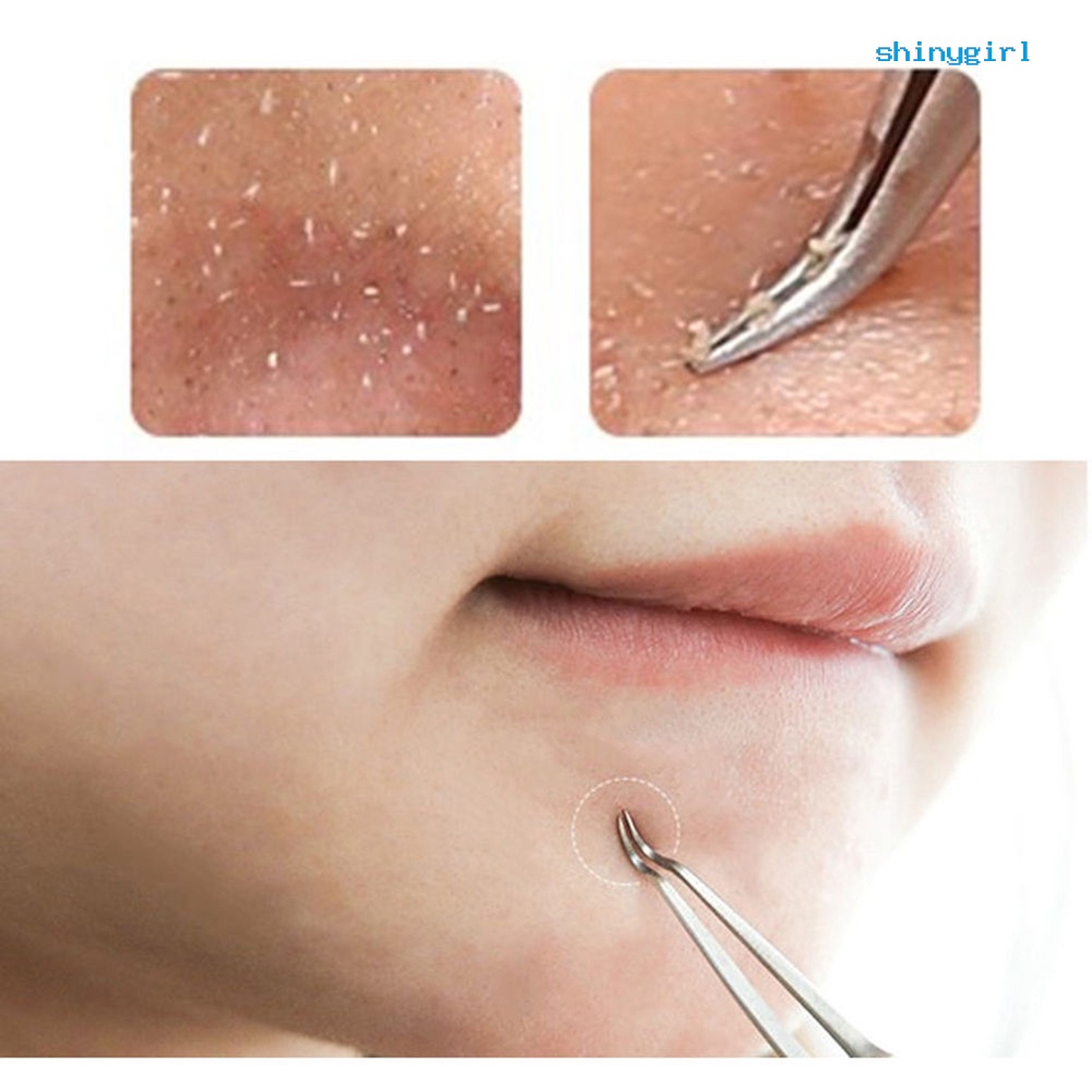 Nhíp Lấy Nhân Mụn Đầu Đen Tiện Lợi