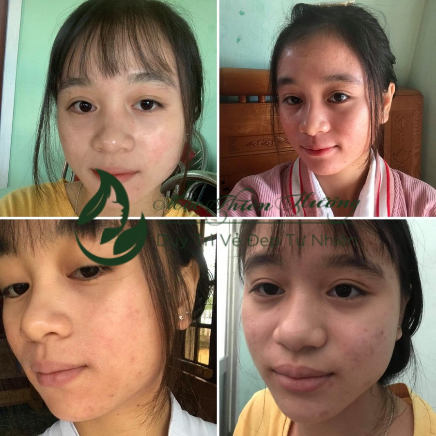 Serum giảm mụn thâm rỗ, sáng da, se khít lỗ chân lông Mộc Thiên Hương 50ml | BigBuy360 - bigbuy360.vn