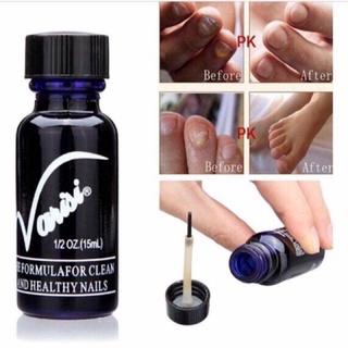 Varisi chống nấm móng tay, nấm móng Chân