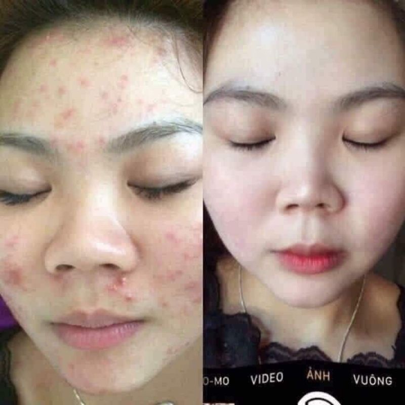 Combo Serum Thảo Dược + Bột Thảo Mộc Sen Spa Mẫu Mới  [ Sạch Mụn - Nám Tàn Nhang - Tái Tạo Da ]