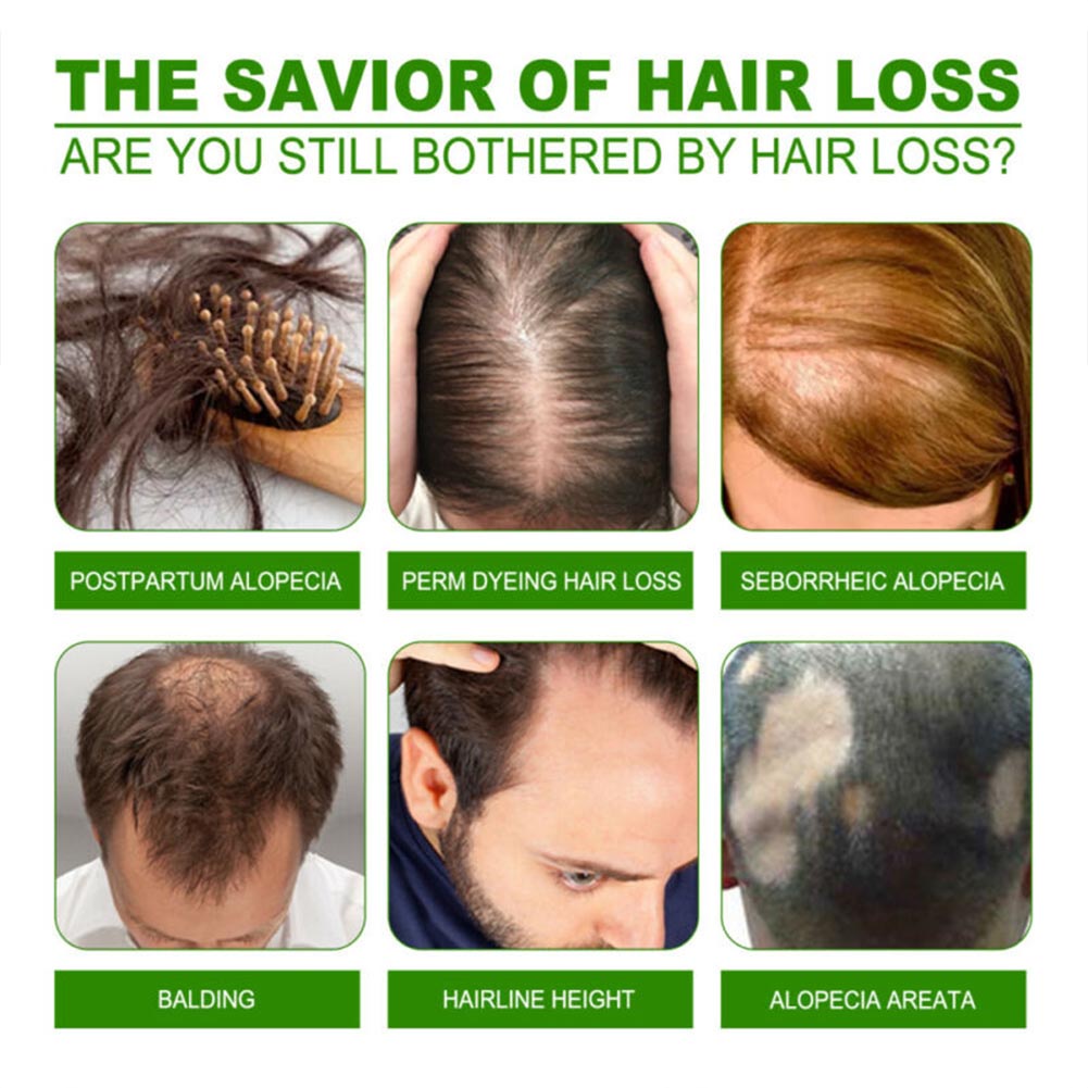 Hair Regrowth Lotion Haircare Hair Loss Oil Baldness Hair thinning 120ml Spray