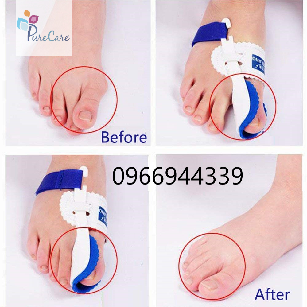 Nẹp duỗi thẳng cho người vẹo ngón chân cái