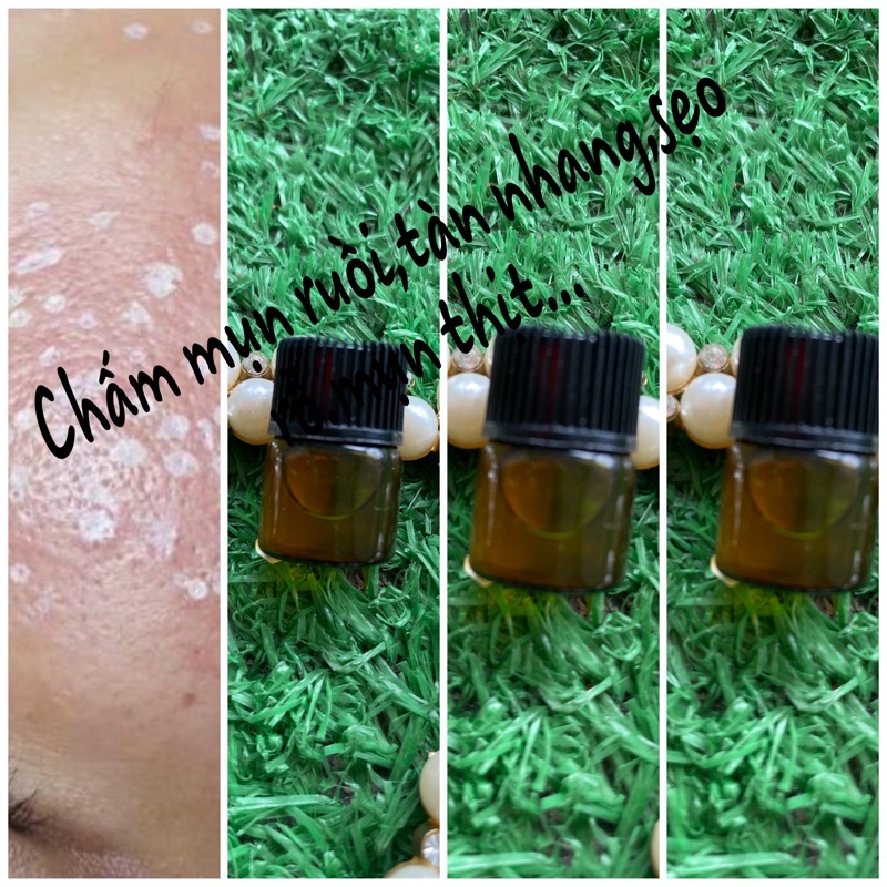 Chấm mụn ruồi ,mụn thịt ,mụn cóc ,seo ỗ kết hợp với cao sẹo