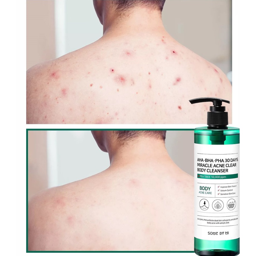 Sữa Tắm Giảm Mụn Lưng Some By Mi AHA BHA PHA 30 Days Miracle Acne Body Cleanser 400ml