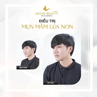 [ Hỏa Tốc ]MẦM LÚA NON MỤN 50ml❤️ - Shynh Beauty
