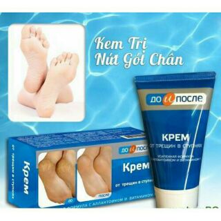 Kem trị nứt gót chân Kpem Apteka của Nga 50ml