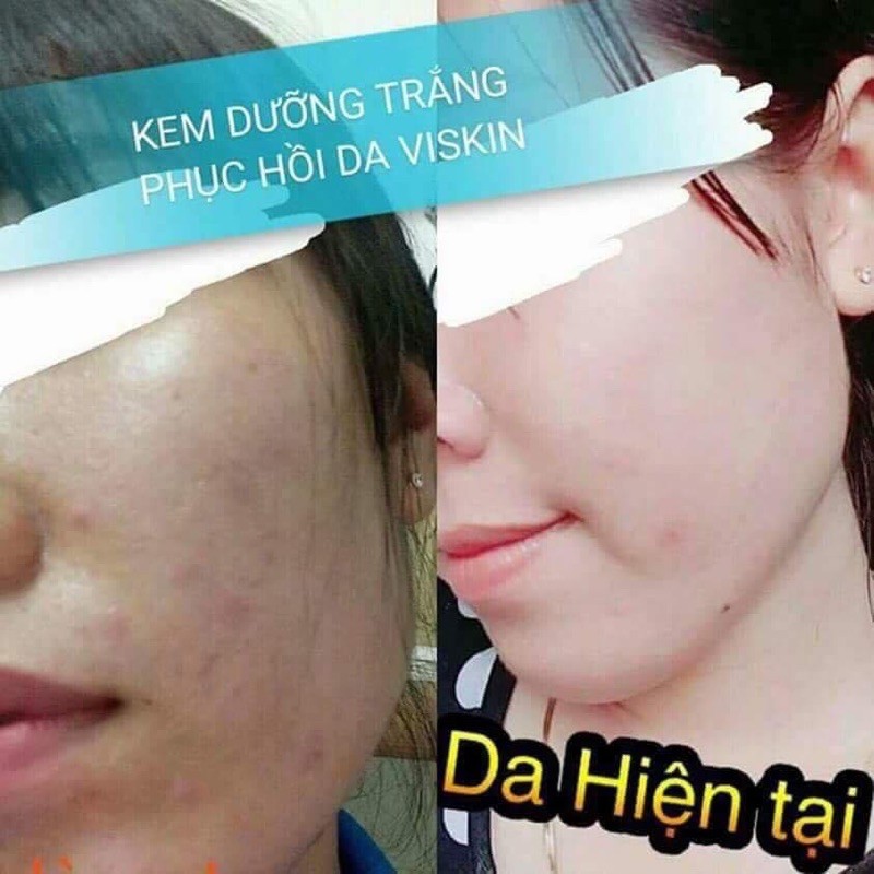 #KEM_DƯỠNG_TRẮNG_THẢI_ĐÔC _PHỤC_HỒI_DA_NHIỄM_CORTICOID_VISKIN