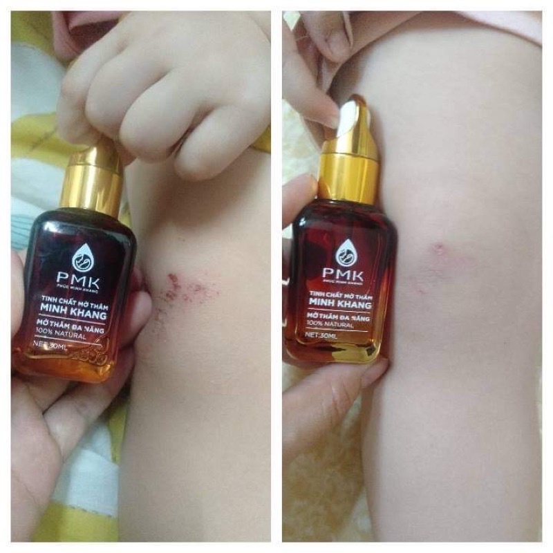 Tinh chất Xóa thâm Minh Khang, Xoá mờ thâm sẹo,thâm mắt, thâm môi,thâm nách,thâm mụn
