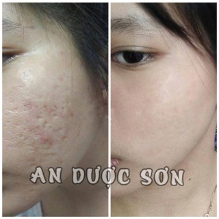 Combo an dược sơn 30ml và bột rửa mặt