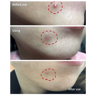 BREYLEE Miếng dán Hỗ Trợ Giảm mụn  cao cấp