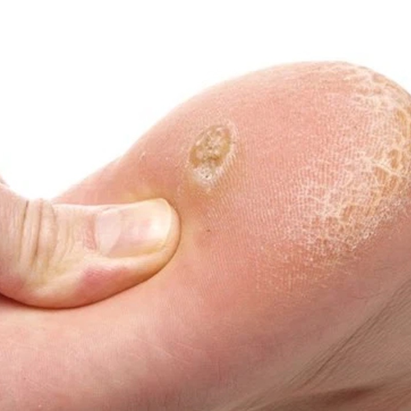 Miếng dán mụt cóc mụn cóc