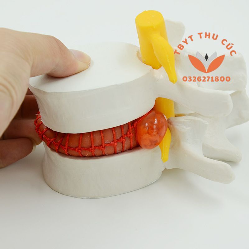 Mô hình thoát vị cột sống