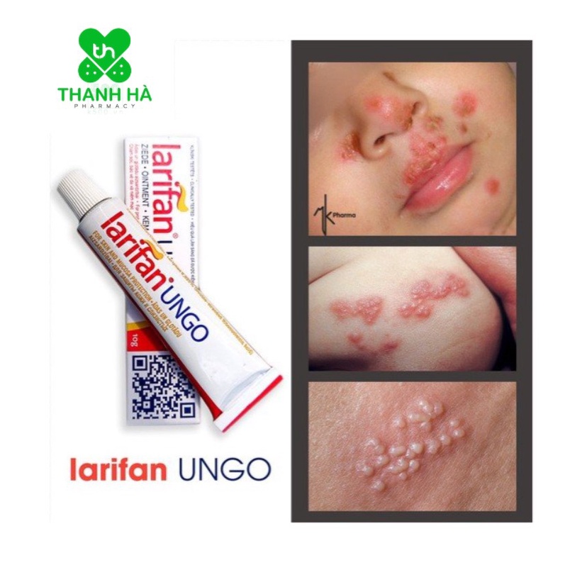 Hàng mới về HERPES - MỤN RỘP, SÙI MÀO GÀ TÁI PHÁT NHIỀU LẦN KHÔNG CÒN LÀ NỖI LO KHI CÓ KEM BÔI LARIFAN UNGO TỪ CHÂU ÂU