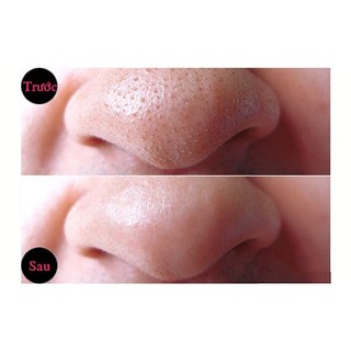 Gel lột mụn  Celona