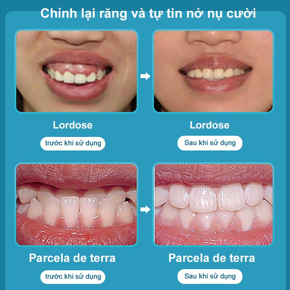  Dụng Cụ Chỉnh Nha Niềng Răng Cofoe Trong Suốt Bảo Vệ Răng Chống Mài Mòn