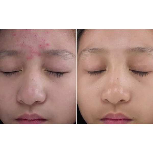 Kem vitamin K phục hồi chuyên sâu, khoẻ lớp biểu bì da Medi Shyn Stem Cell Premium Aesthetic Spa Treatment