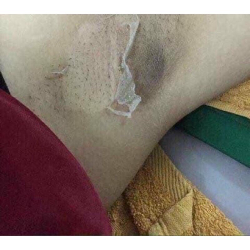 Peel hồng ti,nách, bikini TCA USA | BigBuy360 - bigbuy360.vn