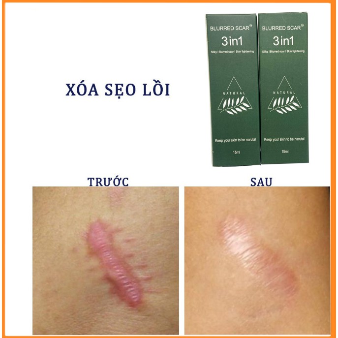 Serum Sẹo Lồi Lõm và Rỗ Lâu Năm BLURRED SCAR