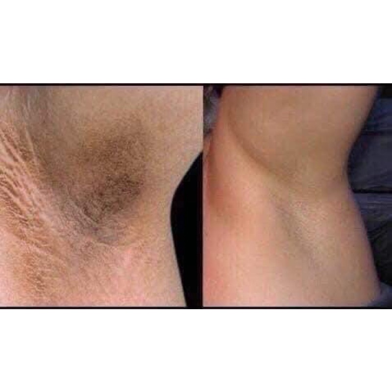 Kem Thâm Nách 88 TOTAL WHITE Chính Hãng 100% Thái Lan