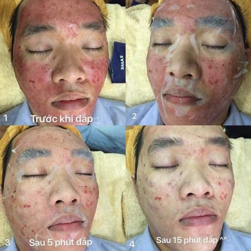 Mặt nạ SMAS Peptide Silk thần thánh giải quyết các vấn đề khô rát bong da, đỏ da do retinol, tretinol, peel da,...