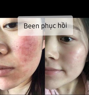 PHỤC HỒI BEEN CHO DA HƯ TỔN
