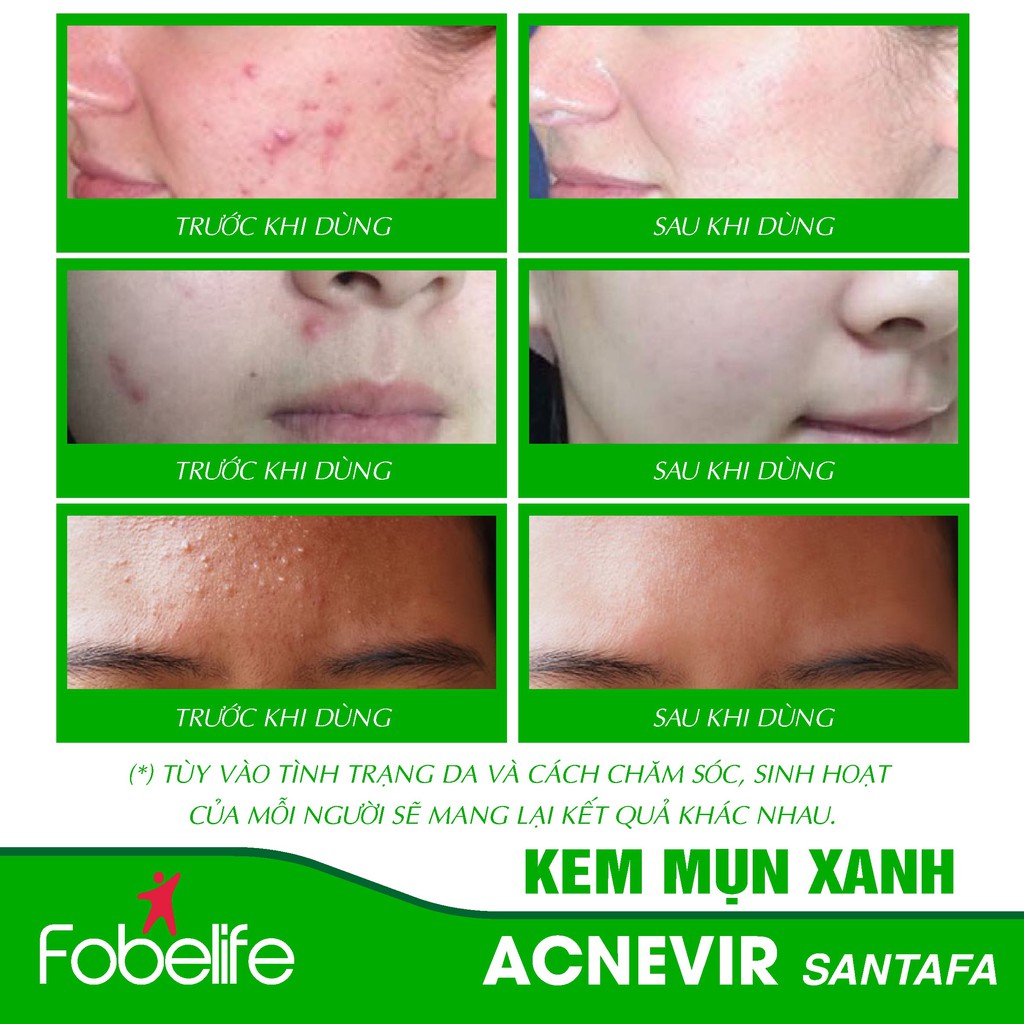 Kem Giảm Mụn Mủ, Mụn Bọc, Mụn Đỏ Và Mụn Trứng Cá  Acnevir Santafa ( Xanh ) tuýp 10gr- Đạt chuẩn GMP | BigBuy360 - bigbuy360.vn