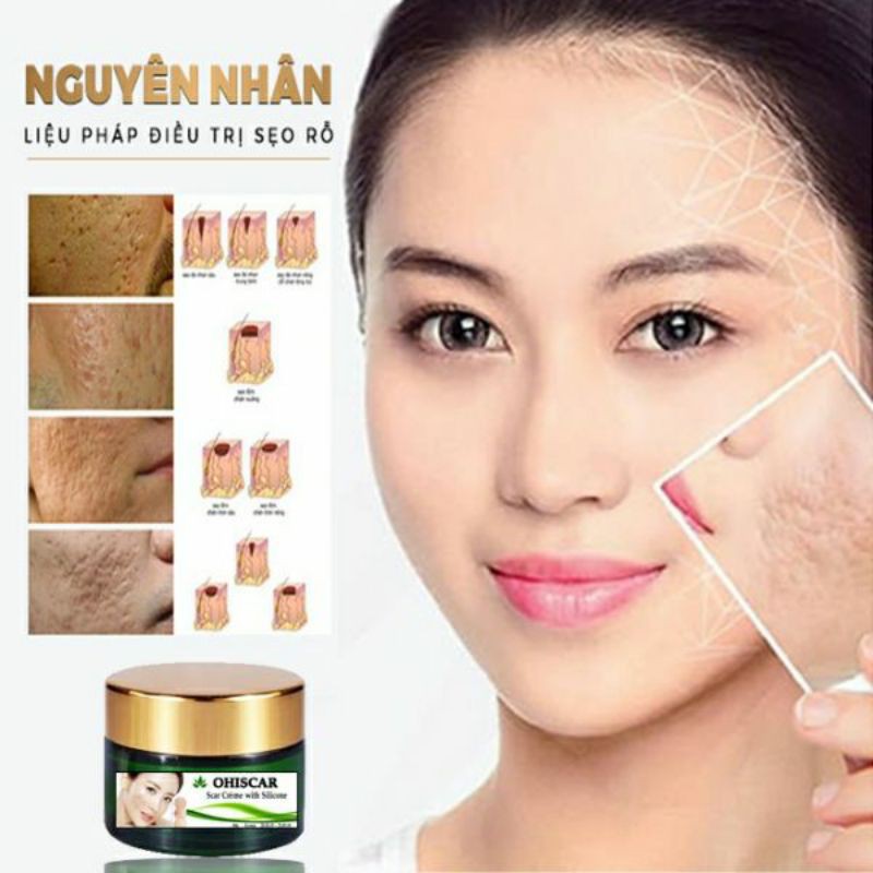 Kem Mờ Sẹo Rỗ Lâu Năm Ohiscar Hàn Quốc