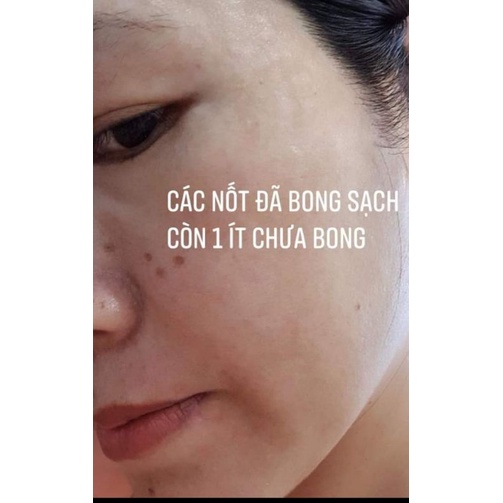 Combo 2 sp chấm nám tàn nhang.
