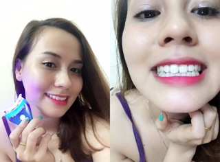 Bộ làm trắng răng  White Light