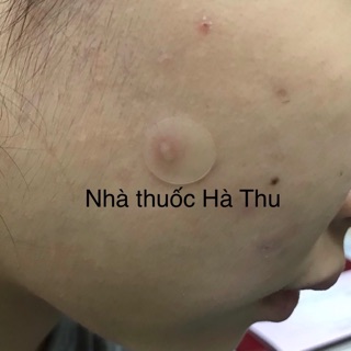 Miếng dán mụn giảm sẹo Somaderm Spot