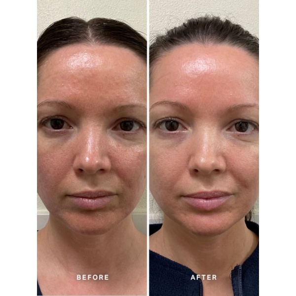 Serum chống lão hóa Alpha H Vitamin B Serum with 5% Niacinamide 1.5ml