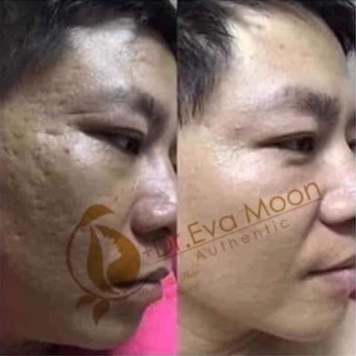 "GIÁ SỐC" Kem sẹo rỗ, sẹo thâm, sẹo rạn , sẹo thủy đậu