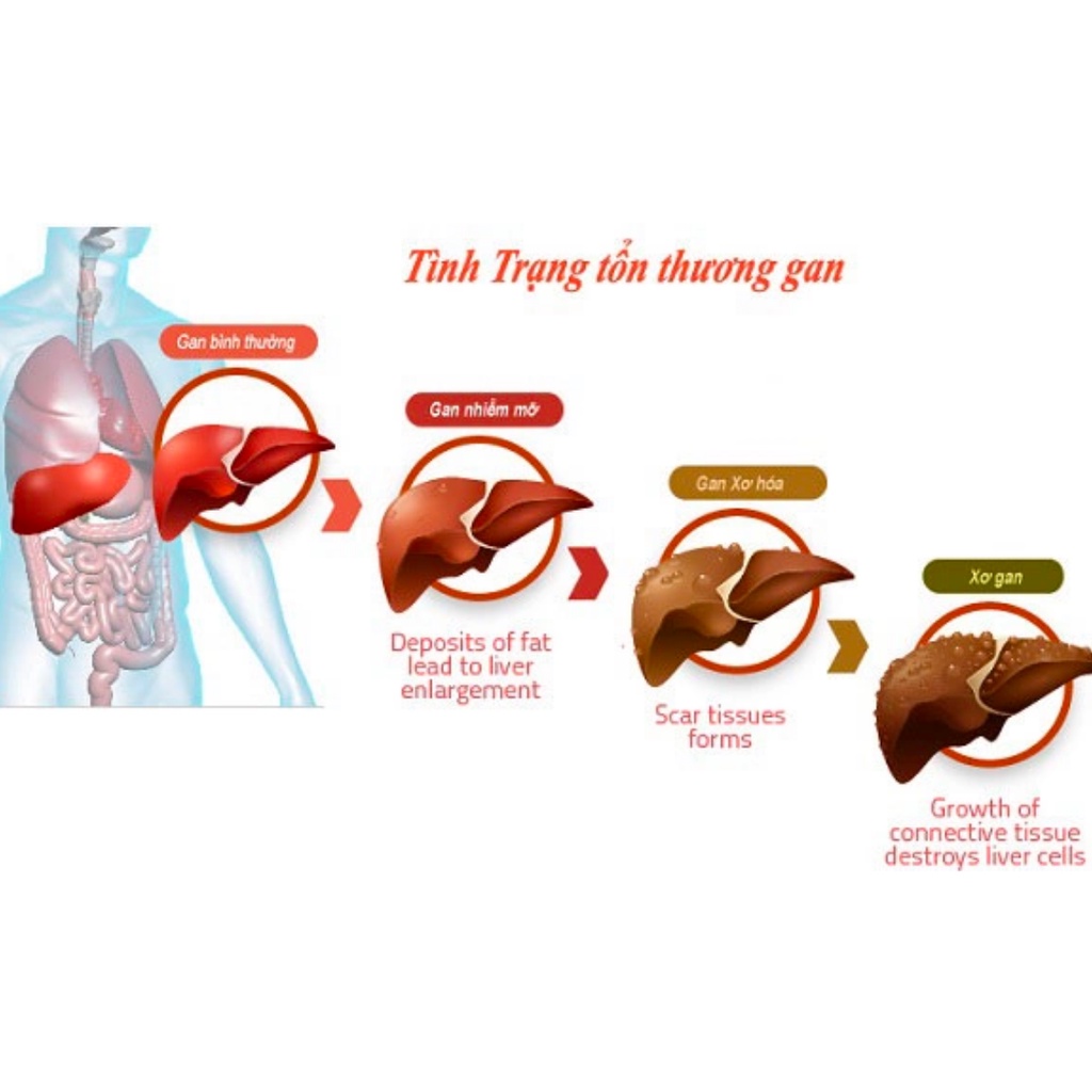 Thuốc bổ gan llyang Parma Hàn Quốc - hỗ trợ viên gan cấp và mãn tính
