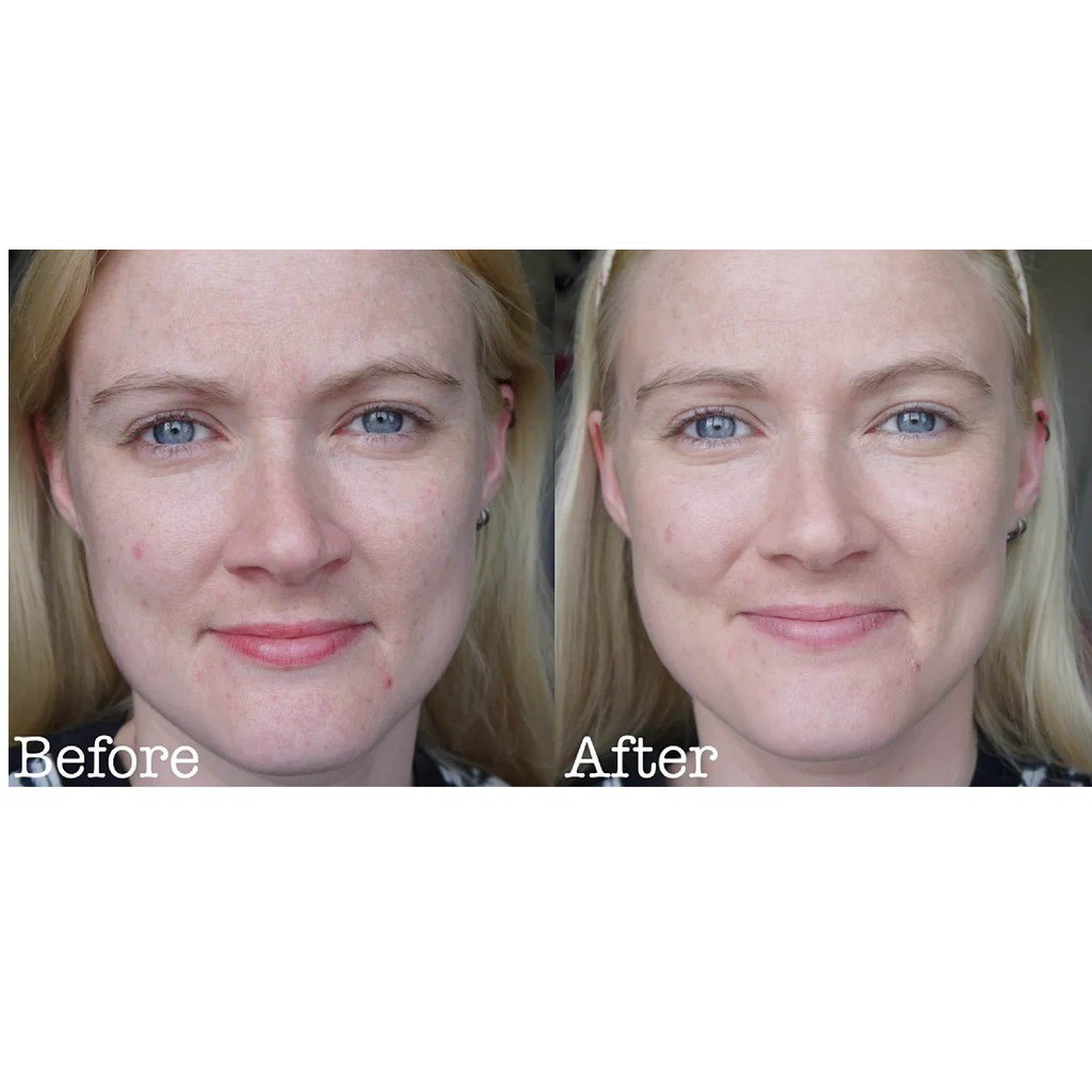 Serum Tean ASA Vàng Loại Bỏ Nám, Thâm Sạm Sau Mụn