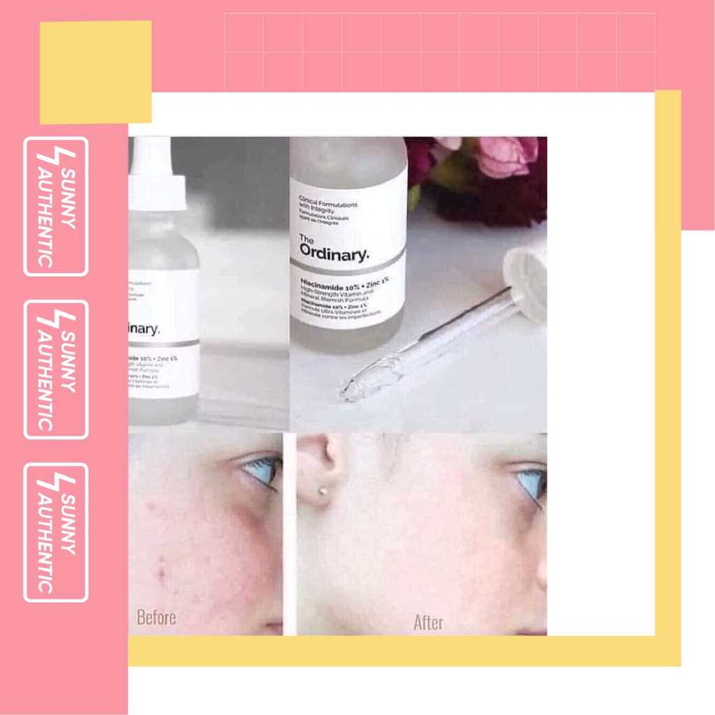 Tinh chất giảm mụn và giảm thâm The Ordinary Niacinamide 10% + Zinc 1%