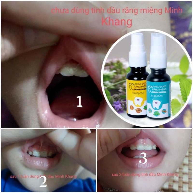 (Mua1 tặng 1)Xịt răng miệng Minh Khang- trắng răng, thơm miệng, hết sâu răng( 15ml)