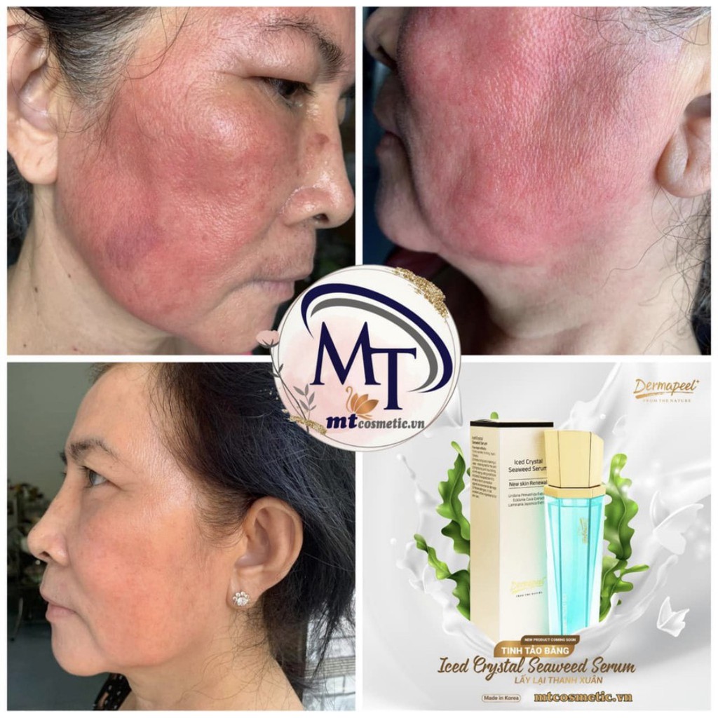 Dermapeel TINH TẢO BĂNG - ICED CRYSTAL SEAWEED SERUM - GIẢM TÌNH TRẠNG DA SƯNG ĐỎ NHANH CHÓNG - PHỤC HỒI DA HƯ TỔN | BigBuy360 - bigbuy360.vn
